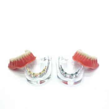 Модель имплантата для ремонта зубов с золотым стержнем, Зубной протез, модель нижней челюсти, модель обучения стоматологии