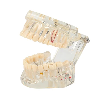 Демонстрация патологии Восстановления зубных моделей на имплантатах полости рта